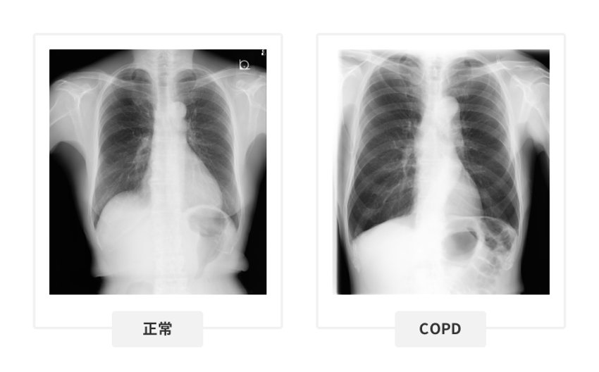 COPD、肺気腫②〜診断、治療について