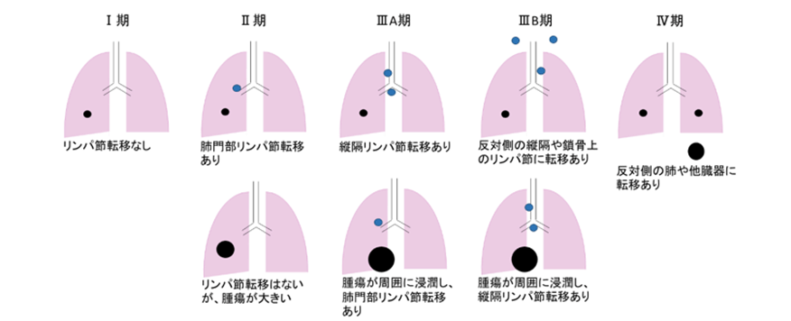 肺癌について～ステージ(病期分類)・転移～